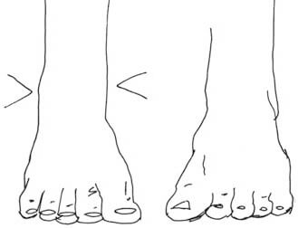 Korrekte Platzierung der Fußknöchel
